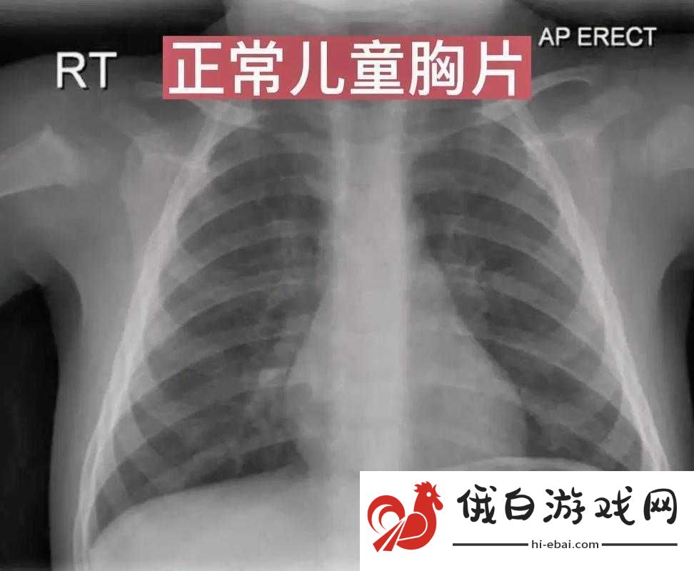 100%胸片曝光率免费